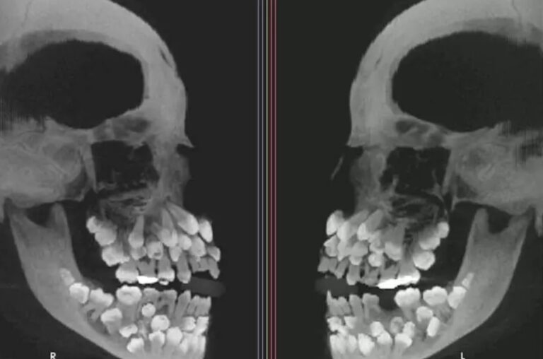 Niña brasileña de 11 años sorprende a los especialistas con 81 dientes