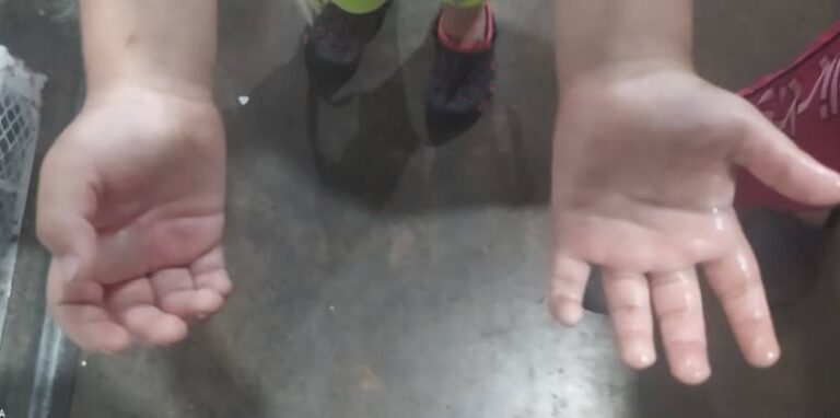 Como castigo por “portarse mal” pareja quemó las manos de sus hijos de dos y seis años de edad