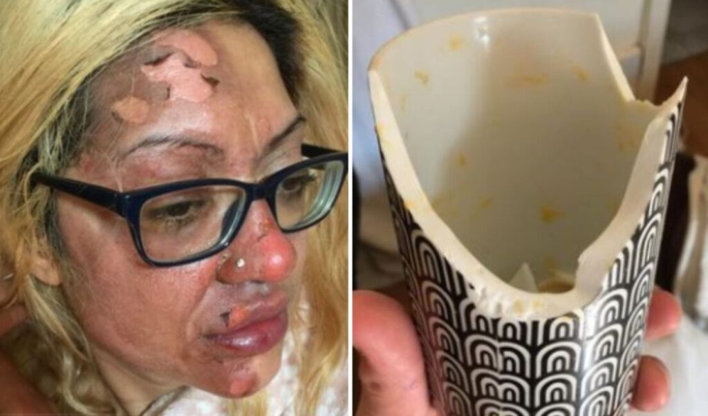 Mujer se quemó el rostro al intentar freír un huevo siguiendo truco de TikTok