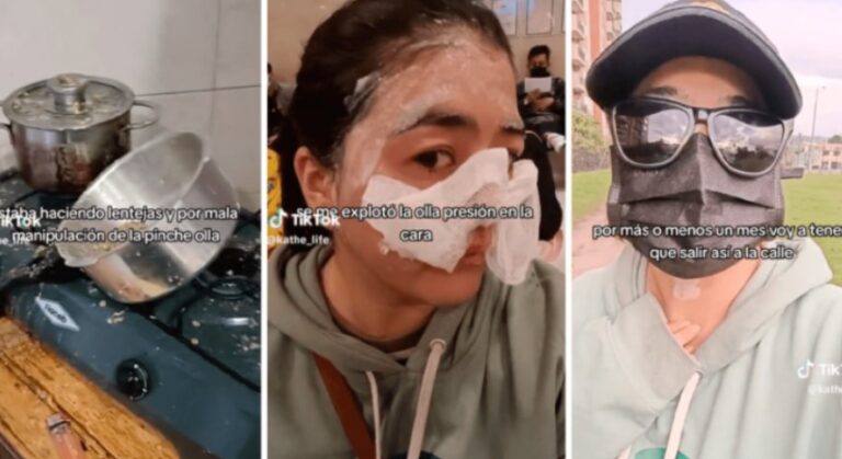 Mujer se quemó la mitad de la cara cuando cocinaba lentejas