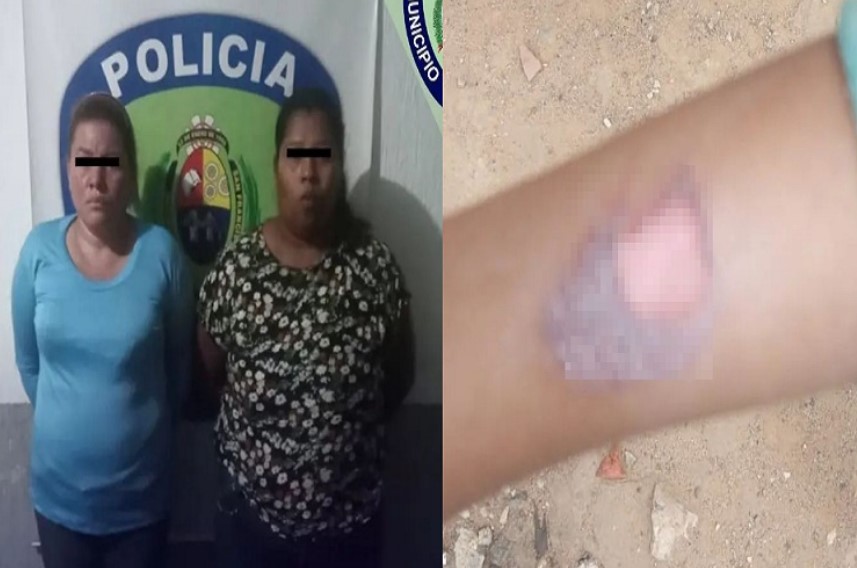 Mujer castigaba a su hija de 5 años quemándola con una cuchara caliente