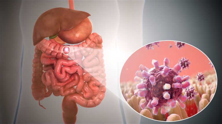 La gastroenteritis infecciosa, un proceso viral