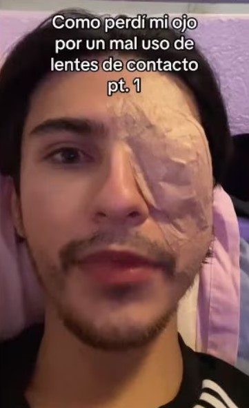 Joven contó cómo perdió un ojo por mal uso de lentes de contacto