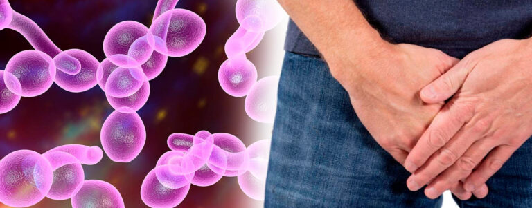 ¿Sabes qué es la candidiasis?