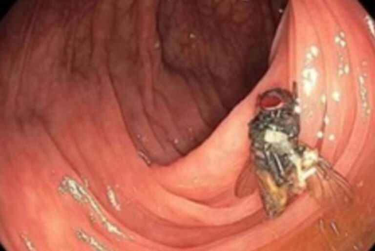 Increíble hallazgo: encuentran mosca viva en el intestino de un hombre durante una colonoscopia