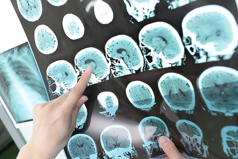La resonancia magnética es el estudio más frecuente para diagnosticar la enfermedad (Foto: Gaceta Médica)